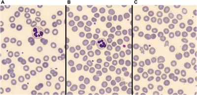 Red Blood Cell Morphologic Abnormalities in Patients Hospitalized for COVID-19